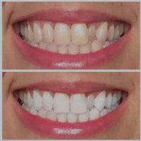 Ultra Violet Teeth Brightening Gel